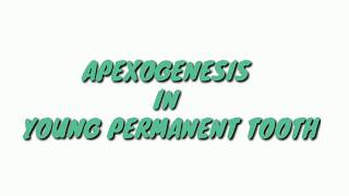 apexificationapexogenesis atozkidsdental APEXOGENESISAPEXOGENESIS IN YOUNG PERMANENT TOOTH [upl. by Orag50]