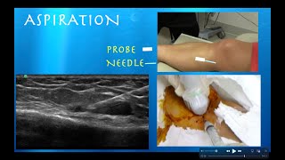 Ultrasound Guided Hoffas Fat Pad AspirationInjection by probeultrasoundcom [upl. by Rabaj]