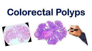 Colorectal Polyps USMLE STEP NCLEX COMLEX [upl. by Ahsonek]