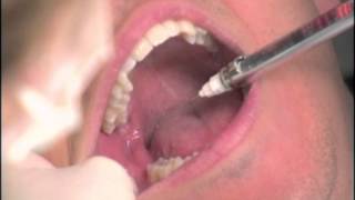 The Dental BoxInferior Alveolar Nerve Block [upl. by Netsruk]