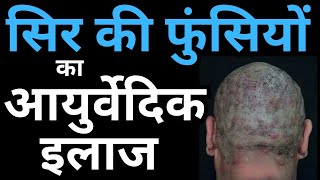 Ayurvedic Treatment for Scalp Folliculitis Causes amp Home Remedies [upl. by Gerladina517]