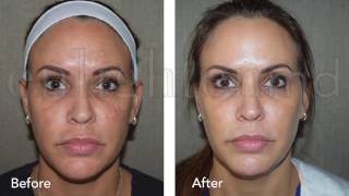 Cosmelan  Melasma Treatment  Enlighten MD [upl. by Aleemaj596]