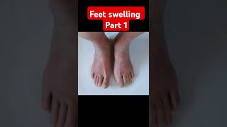 Feet swelling solution tips physiotherapytips foryou viralvideo physiotherapy doctor feet [upl. by Eeloj645]