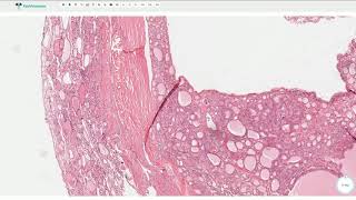 Follicular Adenoma  Thyroid Gland Histopathology [upl. by Roze]