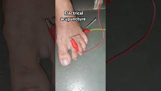 Electrical acupuncture therapy treat Numbness amp pain in the legs acupuncture drRam tending [upl. by Natsyrk]