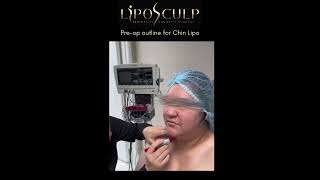 Pre OP Outline For Chin Lipo chinlipo [upl. by Chaing477]