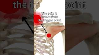 Release Infraspinatus Trigger Points With Dry Needling [upl. by Per]