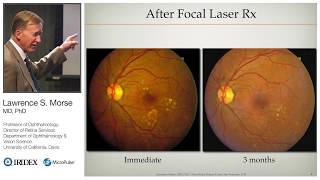 Management of Diabetic Macular Edema with MicroPulse Laser Therapy [upl. by Nidorf]