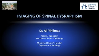 Spinal Dysraphism [upl. by Rockel]