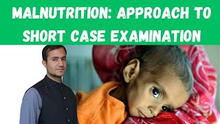 Approach to short case of Malnutrition  Malnutrition in Paediatrics Malnutrition case presentation [upl. by Erna]