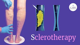 Say Goodbye to Varicose Veins with Sclerotherapy  Animated Varicose Vein Treatment Guide [upl. by Anaeda]