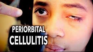 PERIORBITAL CELLULITIS Painful  Dr Paul [upl. by Atimed]