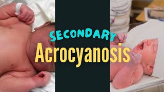 Secondary Acrocyanosis in a Newborn Baby [upl. by Verna]