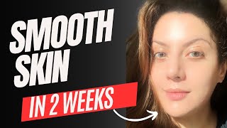 Smooth Skin in 2 weeks Treatment for bumpy textured skin Full routine  Nipun Kapur [upl. by Manwell]