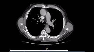 Tomografía de tórax [upl. by Fransen]