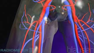 Pulmonary Embolism [upl. by Sanders]