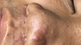 ACNE TREATMENT VU QUYNH MI  Blackheads Chin amp Nose Of Tweens 2024 EX [upl. by Ardnuahs]