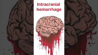 Control of Hyperpyrexia ice therapy during fever sponging during fever reason of hyperpyrexia [upl. by Akiehsal374]