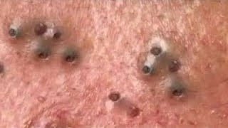 Big Cystic Acne Blackheads Extraction Blackheads amp Milia Whiteheads Removal Pimple Popping  1315 [upl. by Aianat]