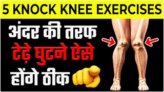 5 Best Knock Knees Correction Exercises 2023  Genu Valgum 2023 [upl. by Flower303]