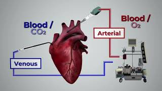 Circulación Extracorpórea ECMO [upl. by Egdamlat85]