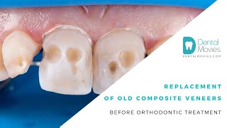 Replacement of old composite veneers before orthodontic treatment [upl. by Akemahc]