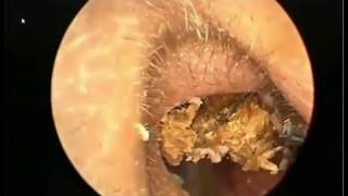 Earwax Removal Extractions UNEXPECTED SIZE Part 1 清理耳内结痂 外耳道挖耳屎清理 耳垢 耳垢 [upl. by Sada88]