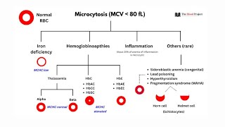 Microcytic anemia  anemia of chronic diseases  sideroblastic anemia Lead poisoning [upl. by Akinej]