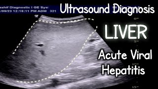 Acute Viral Hepatitis  Ultrasound LIVER [upl. by Oiram]