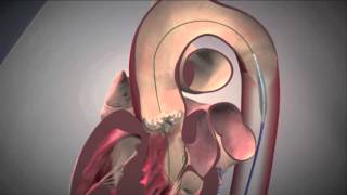 Edwards SAPIEN Transcatheter Aortic Valve Replacement [upl. by Adiv757]