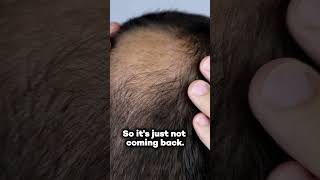 CAN DEAD HAIR FOLLICLES BE REVIVED EXPLORING THE HOPE FOR HAIR REGROWTH [upl. by Assirac243]