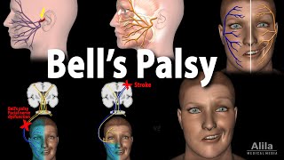 Bells Palsy Pathophysiology Symptoms Diagnosis and Treatment Animation [upl. by Ocinom]