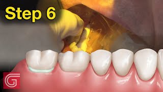 HOW TO Cement Zirconia Crown for Less Retentive Tooth Prep [upl. by Levenson362]