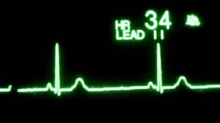 Bradicardia Sinusal  Sinus Bradycardia [upl. by Seravaj]