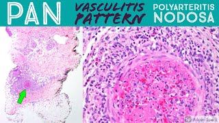 Polyarteritis nodosa amp leukocytoclastic vasculitis pattern Inflammatory Dermpath Basics [upl. by Oecam]