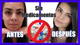 😷 ¿Cómo ELIMINAR el ACNE hormonal en MUJERES ADULTAS con un TRATAMIENTO NATURAL [upl. by Albertine255]