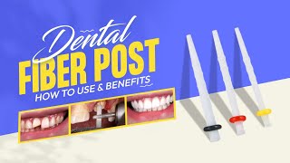 Dental Fiber Post  How To Use amp Benefits  Dentalkart [upl. by Eniamart389]