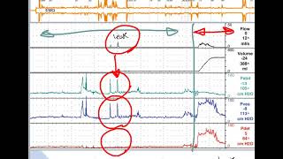 how to interpret cystometry urodynamics [upl. by Avehsile322]