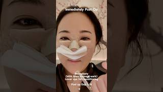 POST OP ➡️ DAY 19  before  after 🙈 koreanbeauty rhinoplastyrecovery lowerbleph [upl. by Cam]