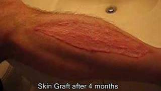 Part 4  Brads Surgery 4 months after graftb [upl. by Tedman]