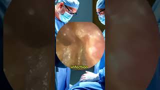 Ear infection Treatment earinfection [upl. by Ythomit]