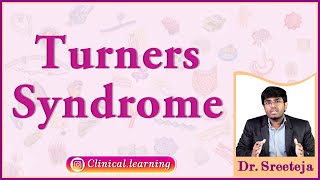 20 Turners Syndrome [upl. by Liz]