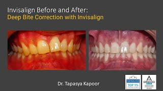 Invisalign Before and After Deep Overbite Treatment [upl. by Kassity]