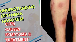 quotUnderstanding Erythema Nodosum Causes Symptoms and Treatmentquot [upl. by Laehcym]