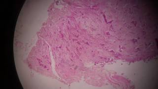 scirrhous carcinoma in breast [upl. by Adriena828]