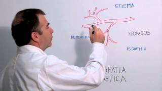 Los efectos de la retinopatía diabética sobre el ojo  Módulo 2  Dr Castro Salas [upl. by Donaugh]