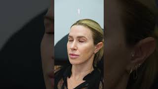 Botox Treatments From Frown Lines to Jawline Definition [upl. by Pavlov]