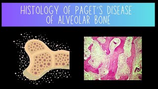 Histology of Pagets Disease of Alveolar Bone [upl. by Salene]