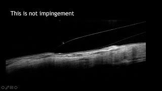 Anterior Segment amp Contact Lens Applications of OCT [upl. by Dennett]