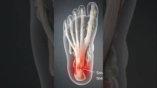 Top 2 Exercises for Plantar Fasciitis Relief plantarfasciitis footpain physio plantarfascia [upl. by Carlin517]